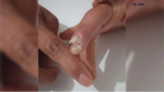 Malatya'da ağır zihinsel engelli bakımevinde darp edildi